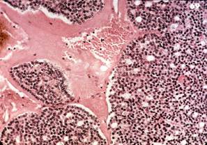 Acinic Cell Carcinoma