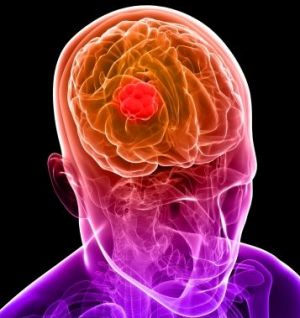 Causes of Brain Cancer