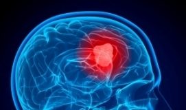 Stages of Brain Cancer Symptoms
