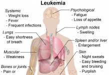 risk of leukemia
