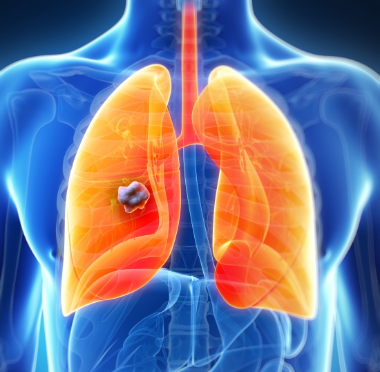 risk factors for small cell lung cancer