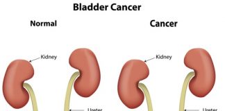 benefits of selenium to prevent bladder cancer symptoms