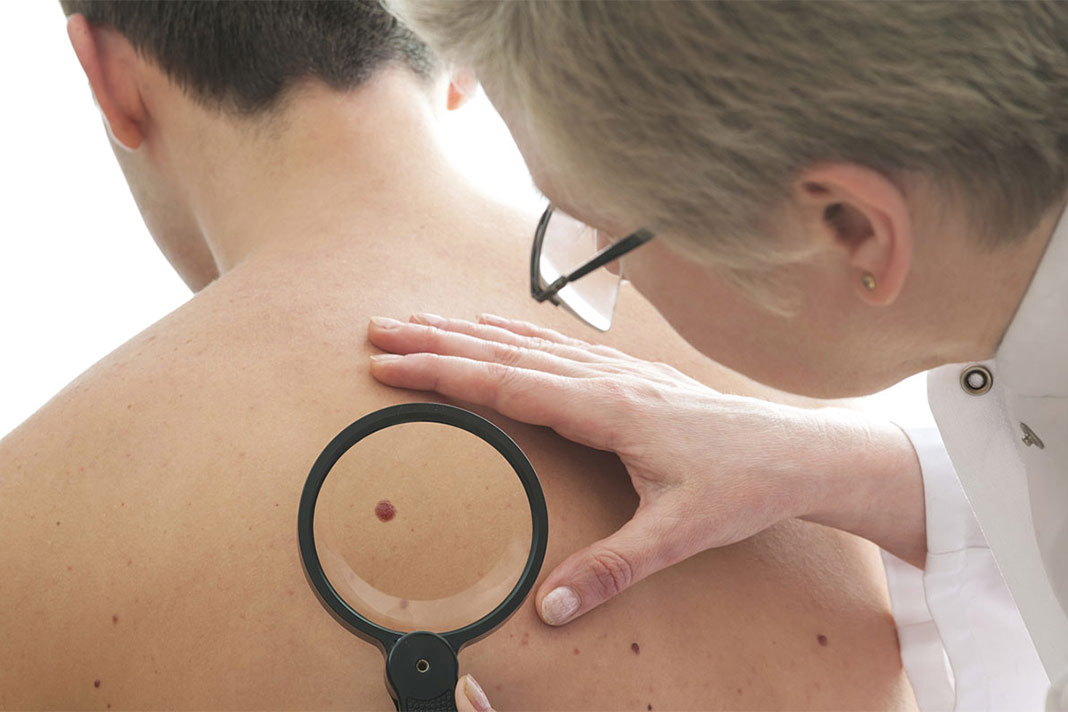 3 Important Things you should know about Melanoma Skin Cancer