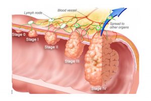 4 Different Stages of Colorectal Cancer