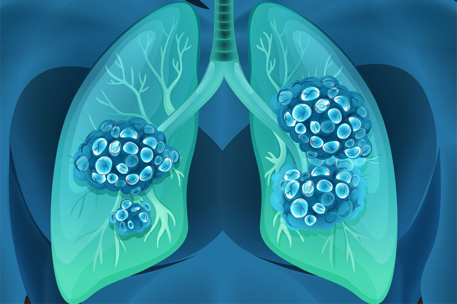The Survival Rate of Each Lung Cancer Stage