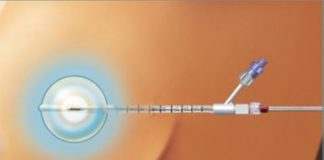 Brachytherapy for Breast Cancer Treatment