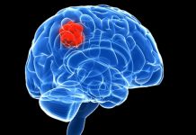 Signs and Signals Indicating Brain Cancer